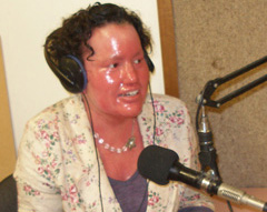 Carly Findlay