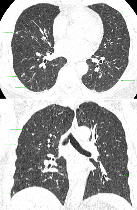 A black and white CT scan shows multiple bilateral soft tissue nodules, many of which demonstrate ground glass attenuation representing thickened bronchioles.