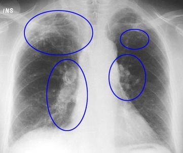 Picture of Silicosis of the Lung