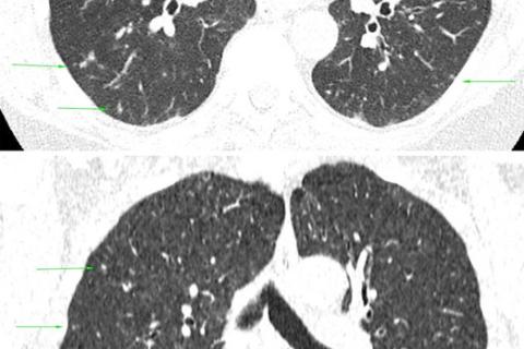 A black and white CT scan shows multiple bilateral soft tissue nodules, many of which demonstrate ground glass attenuation representing thickened bronchioles.